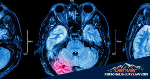 Neurological Injuries Caused By Car Accidents